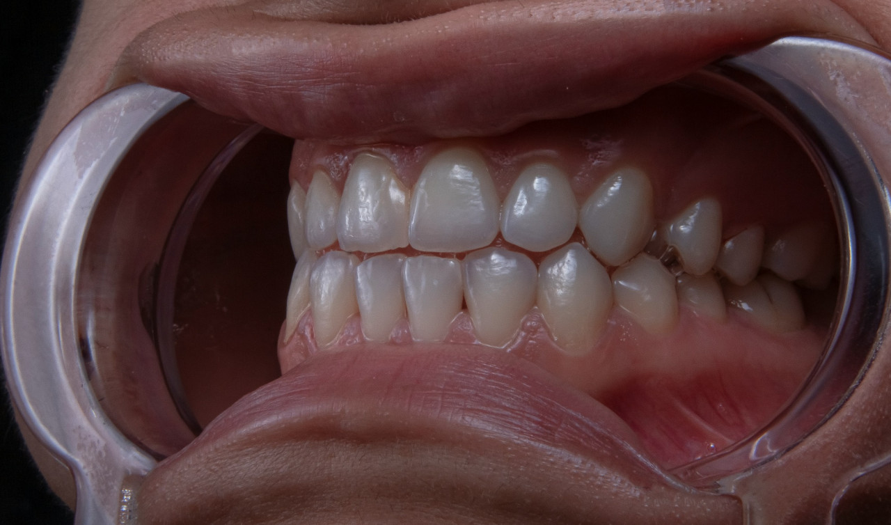 Limpieza dental, dientes. Foto Unsplash